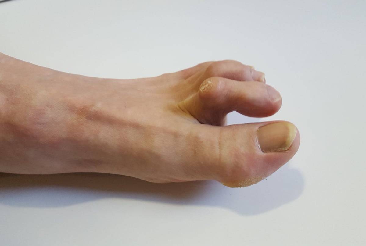 Bunions and Hammertoes
