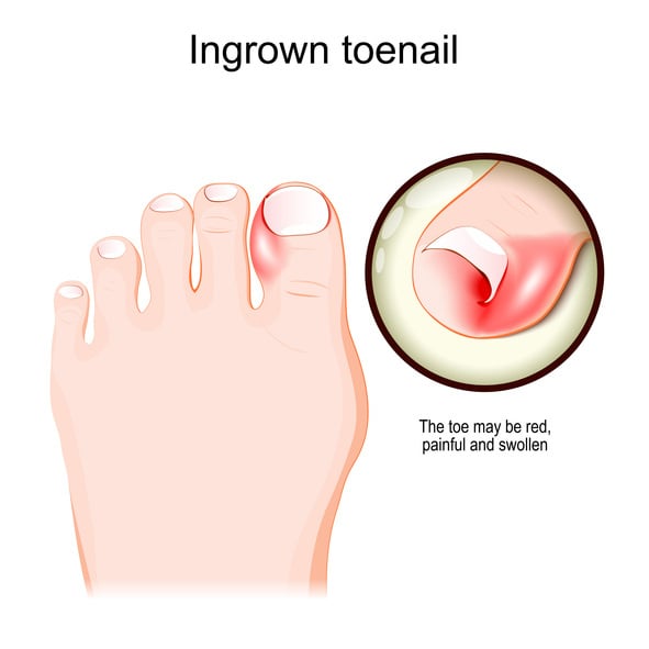 Ingrown Toenail 