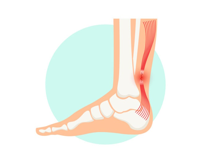 Achilles Tendonitis