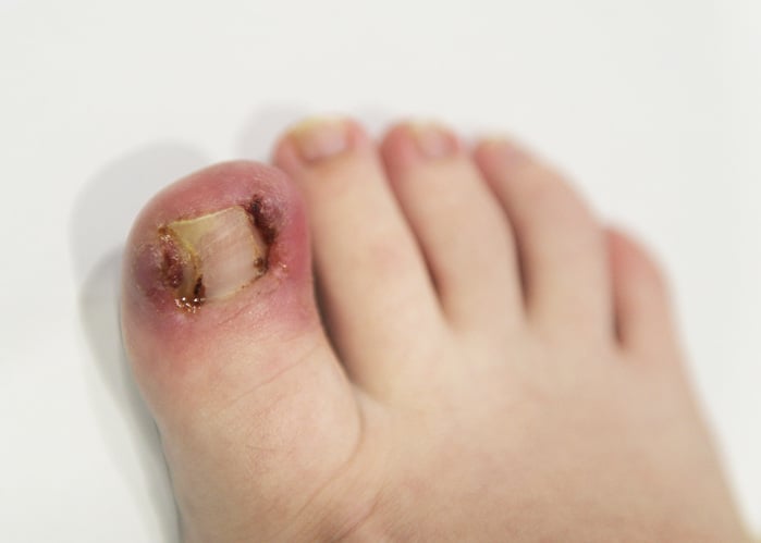 Ingrown Toenail Removal
