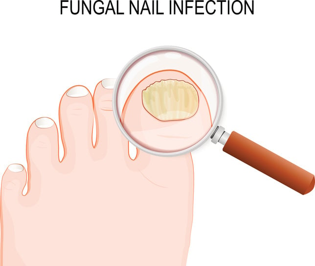 Toenail Fungus