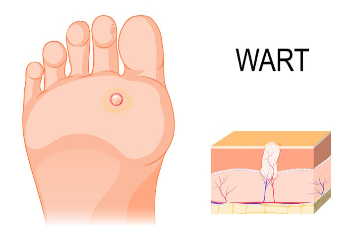 wart